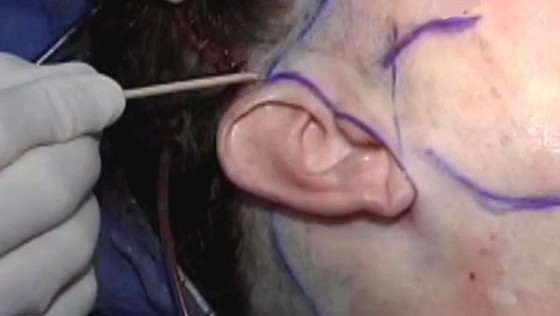 耳前切口面部除皱术