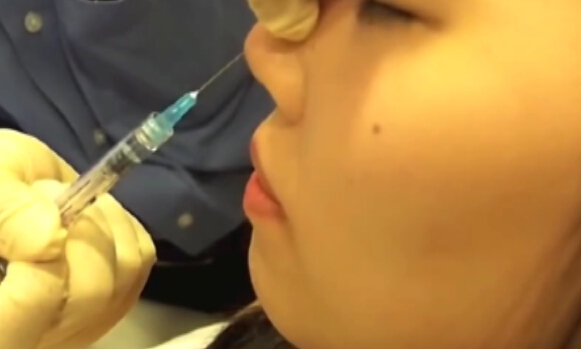 透明质酸注射填充鼻部实操过程