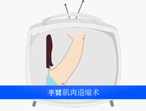 手臂吸脂术动画演示视频