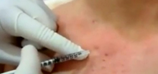 玻尿酸颈上胸除皱