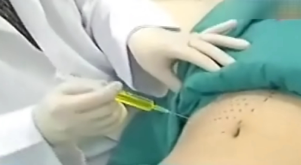 消脂针溶解脂肪？FDA警告：未证实