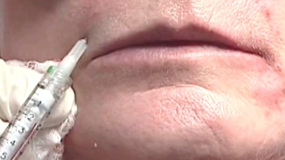 玻尿酸注射面部除皱术