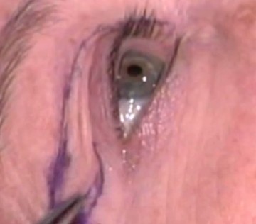 上睑下垂矫正术