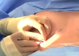 生理盐水可以做假体隆胸吗？