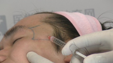 注射填充玻尿酸丰颞