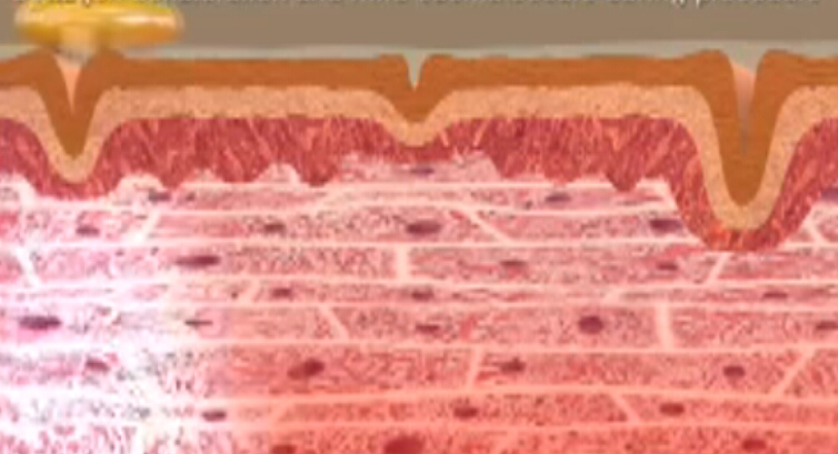 动画解析电波除皱