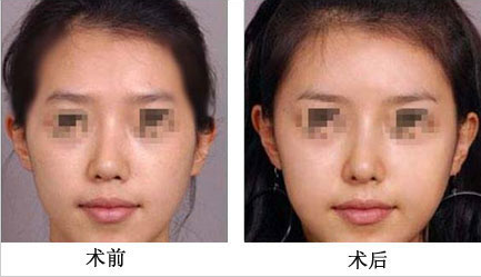 玻尿酸填充太阳穴前后对比图