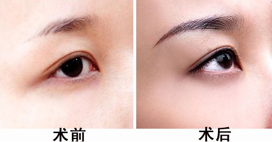 眉部整形之一个植眉的自白