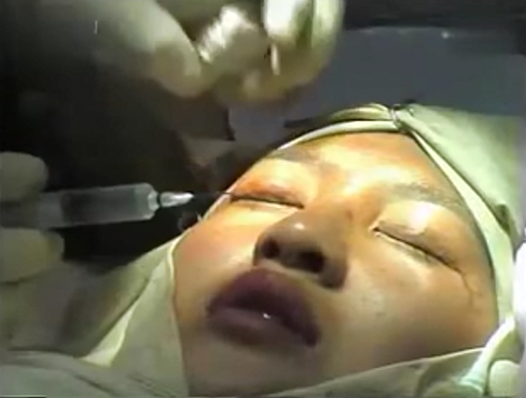 埋线重睑+内眦开大术