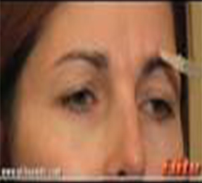 肉毒杆菌注射治疗眉间纹、鱼尾纹