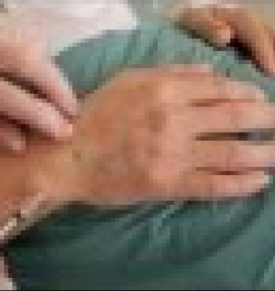 ELLANSÉ™缓解手背部衰老