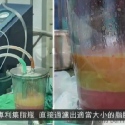 抽脂—自体脂肪丰胸