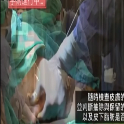 整容外科手术：手臂部的吸脂