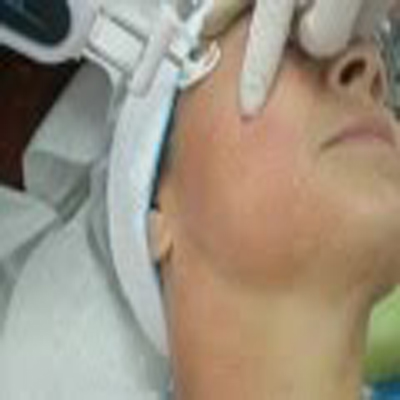 PRP机器施打美容保养皮肤