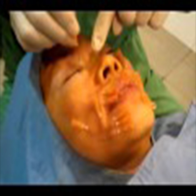 面部埋线：提拉面部