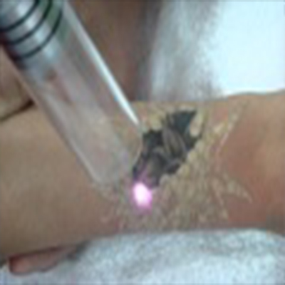 白瓷娃娃洗除纹身