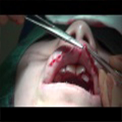 外科整容：嘴唇切薄手术