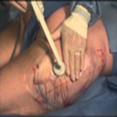 BodyTite无创溶脂