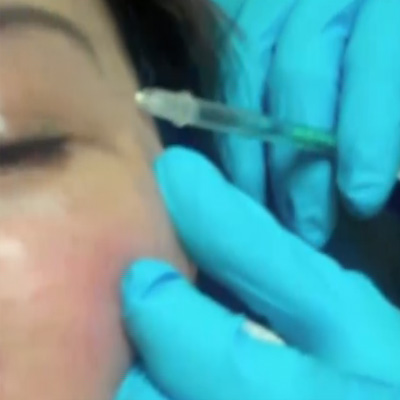 肉毒注射多方位消除皱纹