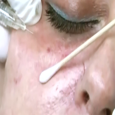 医学美容注射消除泪槽