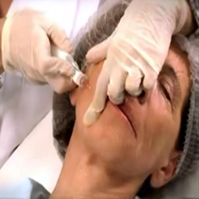 Restylane Vital填充面部1