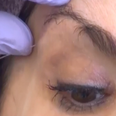 上眼睑与眉毛的填充