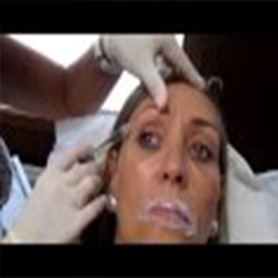 皮肤填充剂快速抬眉