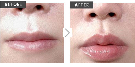 微整形丰唇的方法有哪些