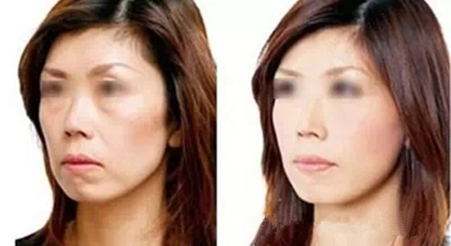 微整形是怎么让人变美